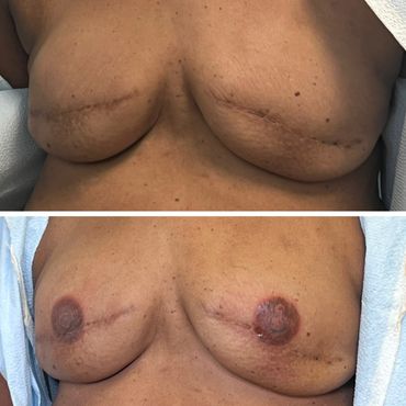 Before and after breast reconstruction surgery showing healing scars and nipple restoration.
