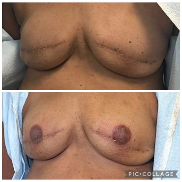 Before and after breast reconstruction surgery showing healing scars and nipple restoration.