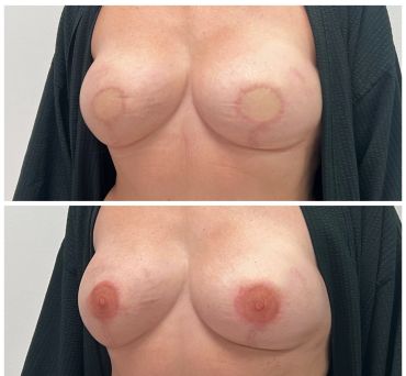 Before and after breast areola tattooing for a natural look.