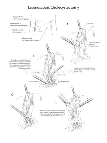 Laparoscopic Cholecystectomy