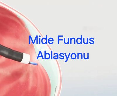 Mide Fundus Ablasyonu diğer adi ile Gastric Fundus Ablation endoskopik bir zayiflama yontemidir.