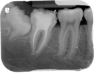 Molar Root Canal Dr. Albert Natanov