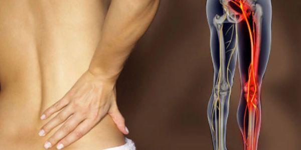 Sciatica Pain Treatments Brisane - Resolve shooting leg pain fast at Knead