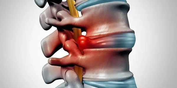 spine disc bulge, disc herniation, slipped disc, hernia, lumbar herniation,