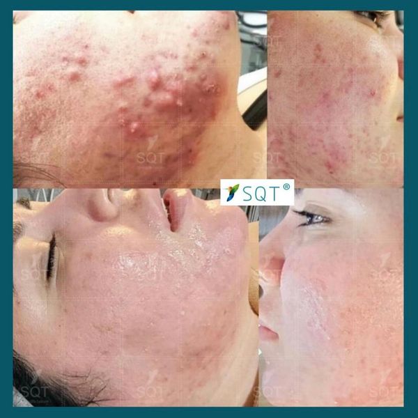 Acne treatment Swindon psoriasis treatment Swindon eczema treatment Swindon 