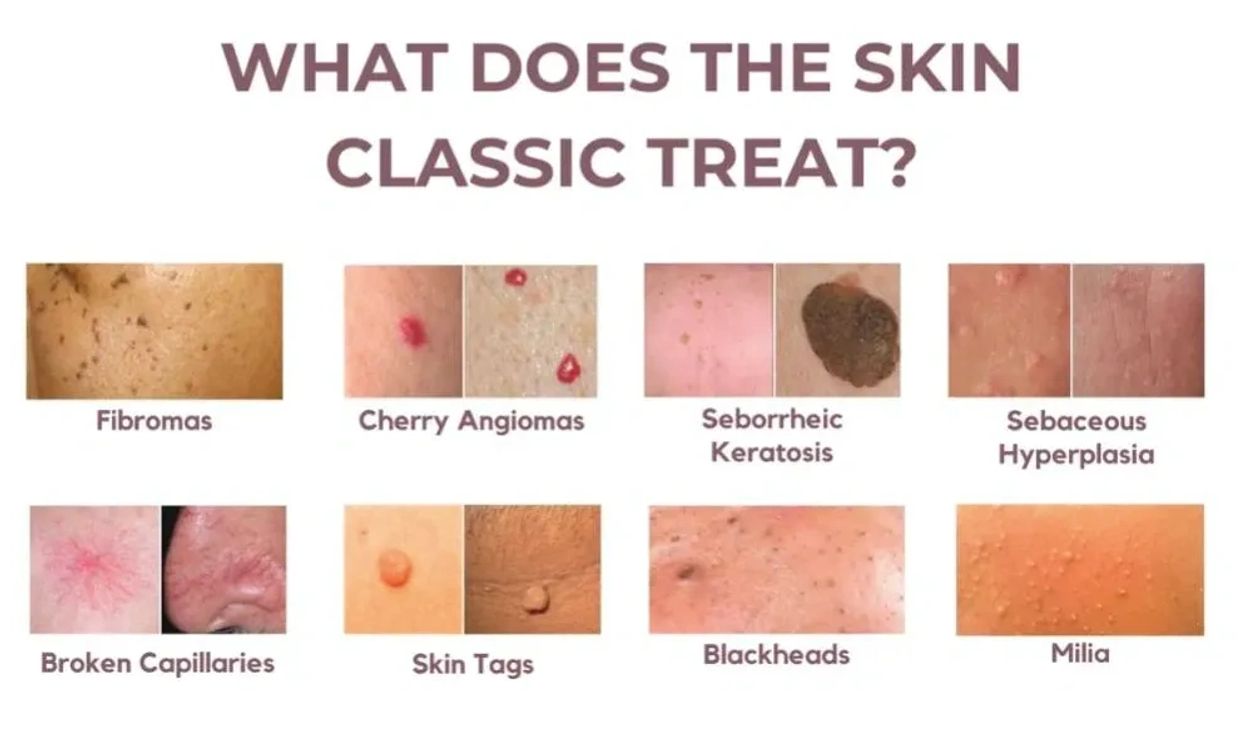The Skin Classic treats various skin issues like fibromas, cherry angiomas, and blackheads.