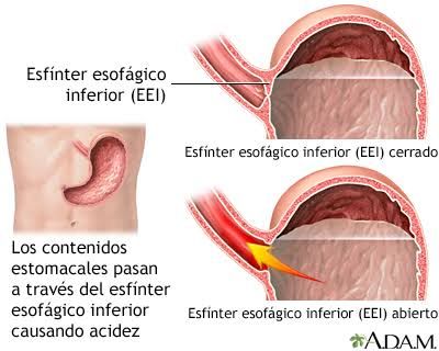 Enfermedad por reflujo gastroesofagico (ERGE)