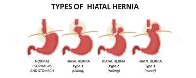 Diferentes tipos de hernia hiatal