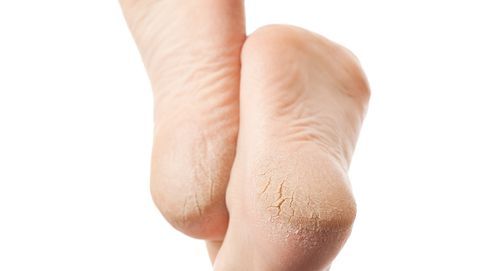 What are heel fissures?