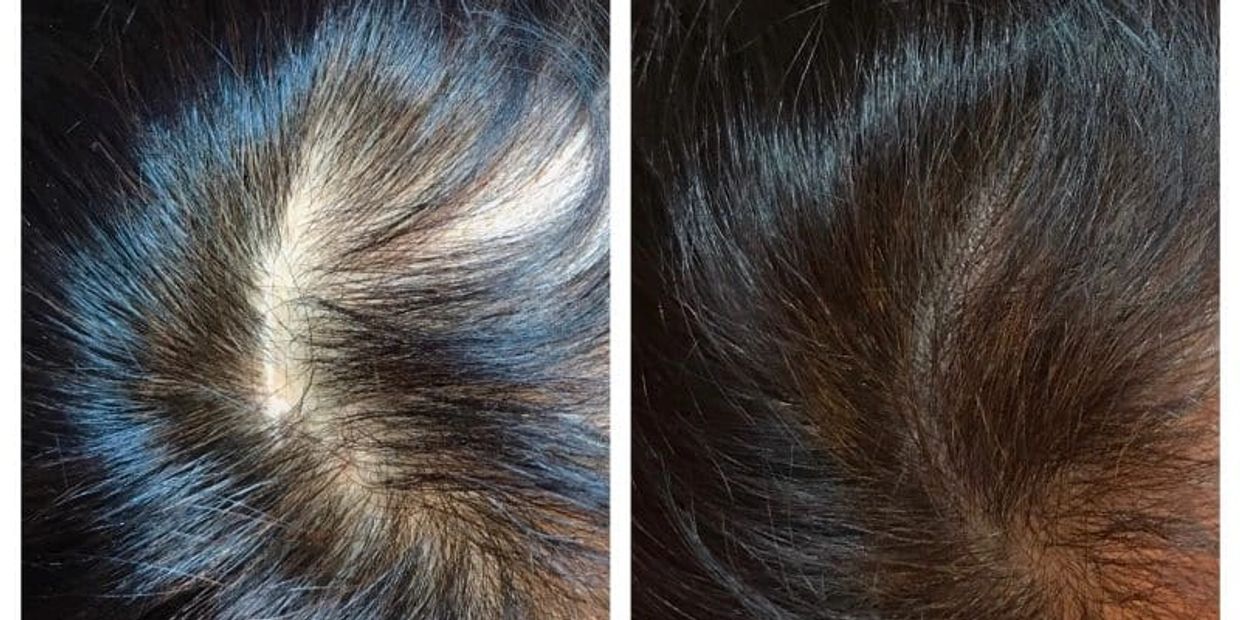 Scalp Micropigmentation | ILuxe Glo