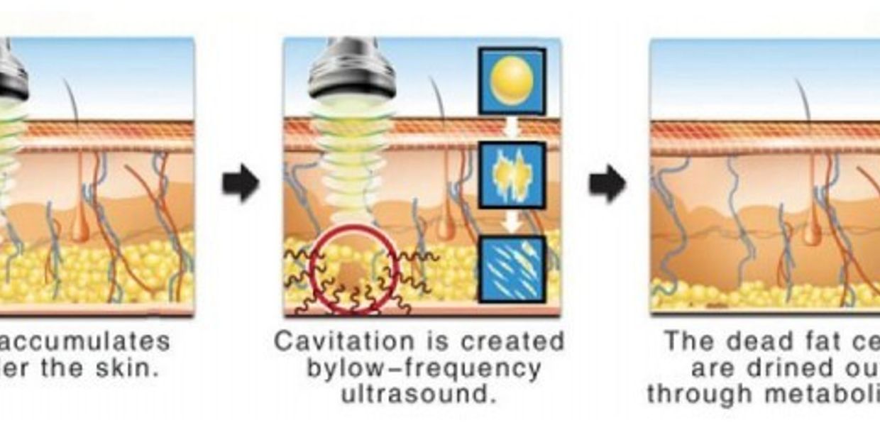 Ultrasound Cavitation & Radiofrequency
