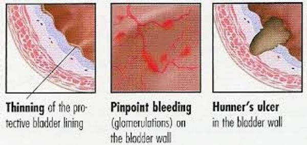 What Helps Interstitial Cystitis Flare Up