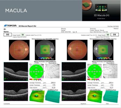 B-Scan of Macula