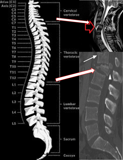 Spinal vertebrae labeled with imaging highlights