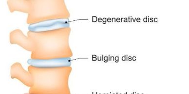 Diagram showing degenerative and bulging discs in the spine.
