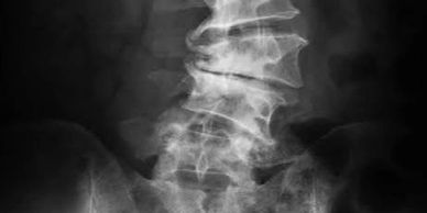 X-ray of fractured lumbar spine.