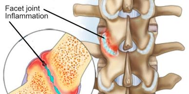 Facet joint inflammation in the spine.