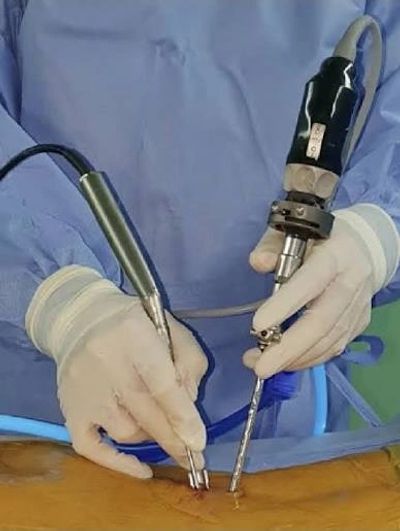 Surgeon performing minimally invasive surgery with laparoscopic tools.