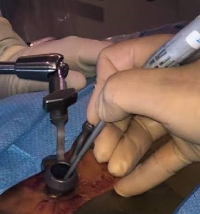Surgical procedure using specialized tools on skin.