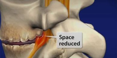 Jaw joint with reduced space shown.