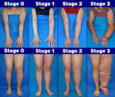 Stages of Lymphedema 