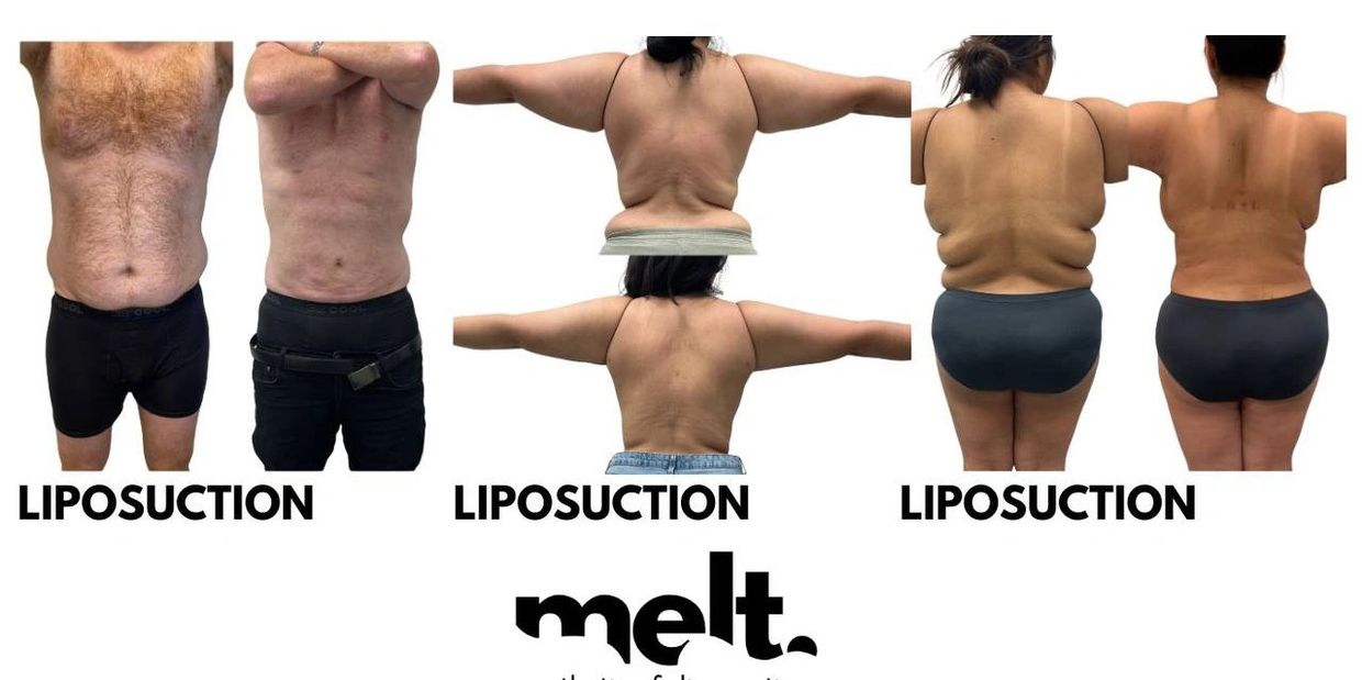 liposuction results