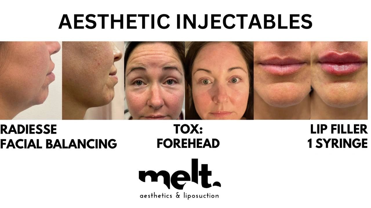 Botox Injections - Scottsdale, Arizona - Melt Aesthetics and Liposuction Arizona Melt Aesthetics and Liposuction Arizona Botox Injections - Scottsdale, Arizona - Melt Aesthetics and Liposuction Arizona