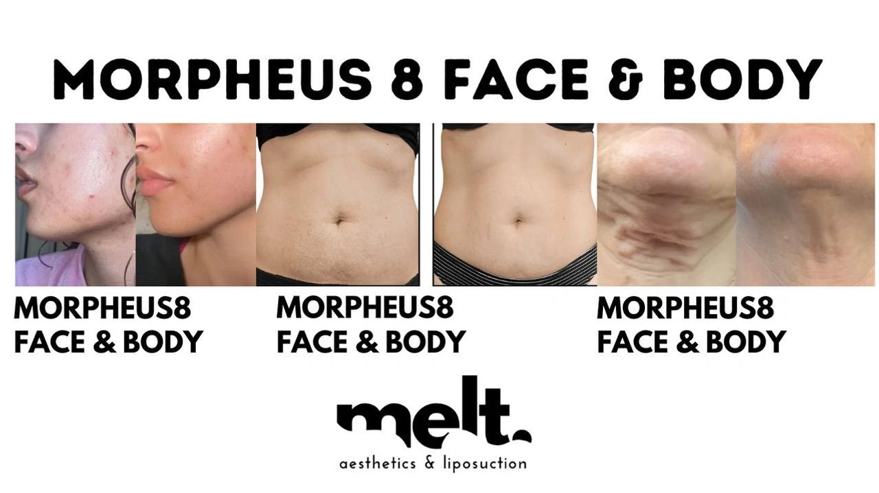 Scottsdale Morpheus8 Microneedling