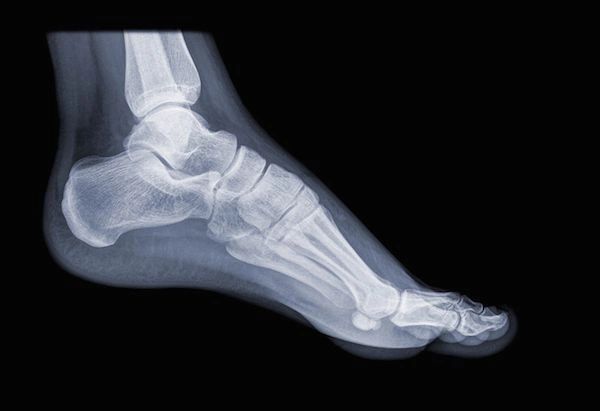 FRACTURES AND TRAUMA OF FOOT ANKLE FRACTURES AND TRAUMA OF FOOT ANKLE