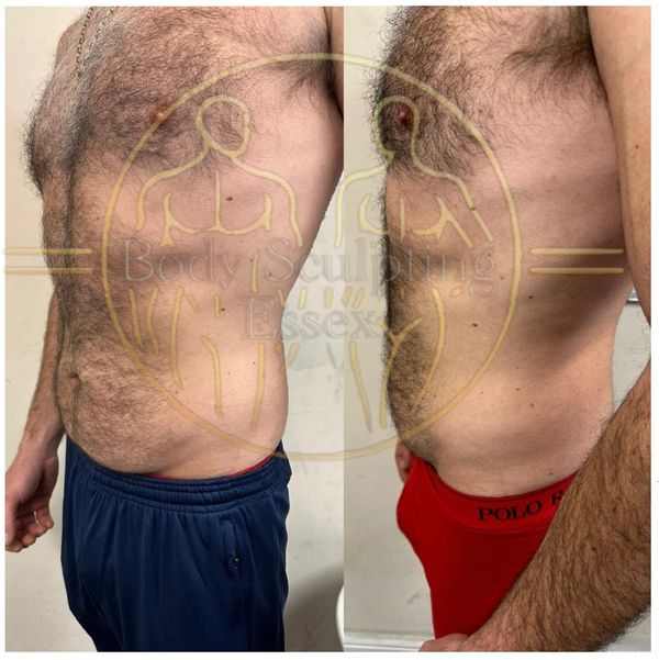 Body Sculpting in Epping, Essex, weight lose.