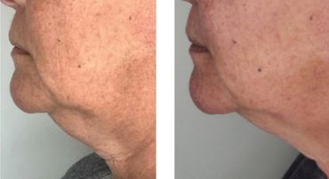This is just ONE treatment (she can have up to 3) of Belkyra/Kybella for fat under the chin