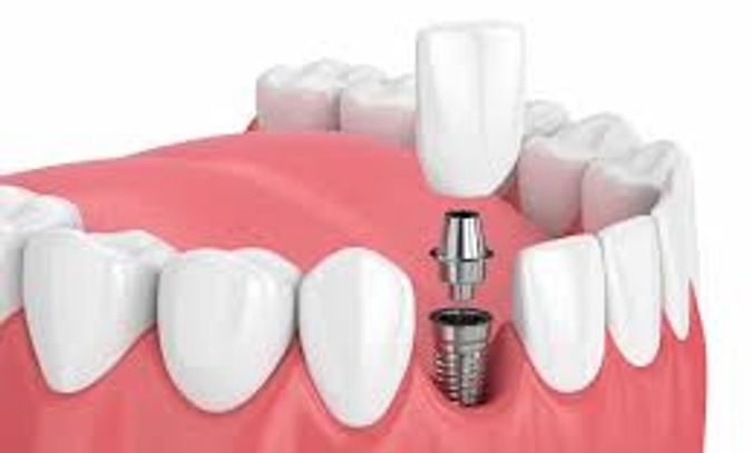 Illustration of a dental implant procedure on a lower jaw.