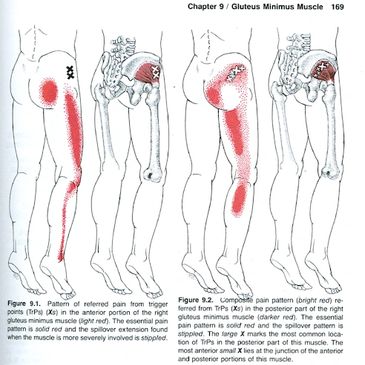 TDN, Trigger Point Dry Needling, Katherine Hauska, Becca Mohrbacher, Chris Shott