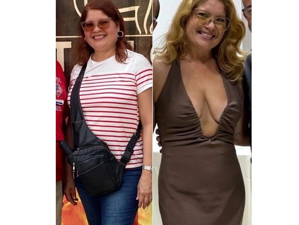 Before-and-after photos of a female patient showing her progress during a medically supervised weigh
