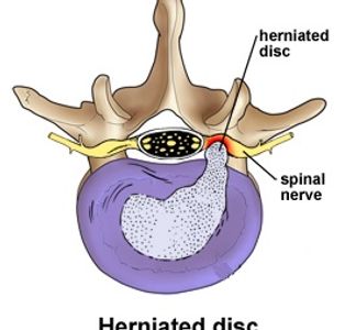 Chiropractor Allentown PA, disc bulge, disc herniation, disc hernia, slipped disc, ruptured disc