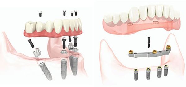 Edmonton Dentures|Dental Implants|All on four Dentures|Implant Dentures|Alberta Dentures|Denturist