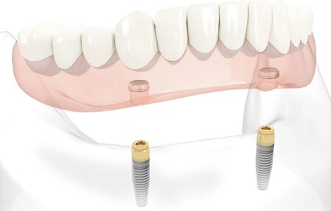 Edmonton Dentures|Dental Implants|Locator Dentures|Implant Dentures|Alberta Dentures|Denturist