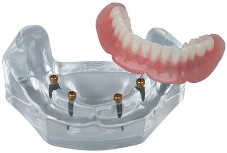 Fixed/Non Removable Teeth on Implants - Hood River, The Dalles, Hermiston –  Your Denture and Implant Specialist