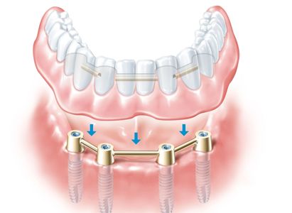 Fixed/Non Removable Teeth on Implants - Hood River, The Dalles, Hermiston –  Your Denture and Implant Specialist