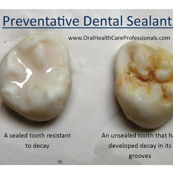 Dental Sealants For Adults