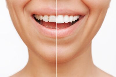 side by side comparison of before and after veneers