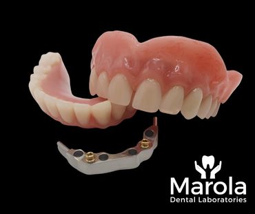 Acrylic denture on implant bar