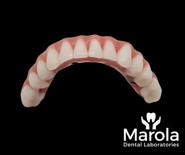 Acrylic denture on an implant bar 