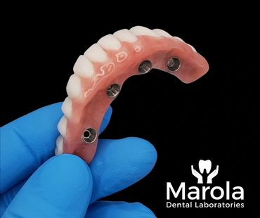 Acrylic denture on implant bar