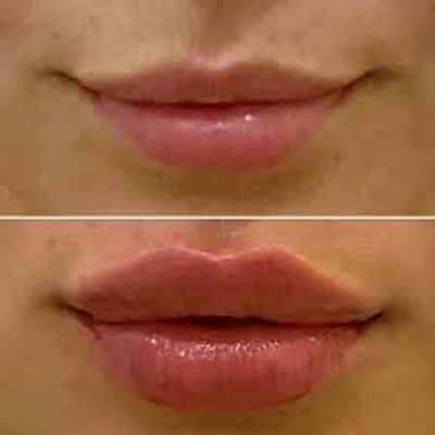 Needless Hyaluronic lip Filler