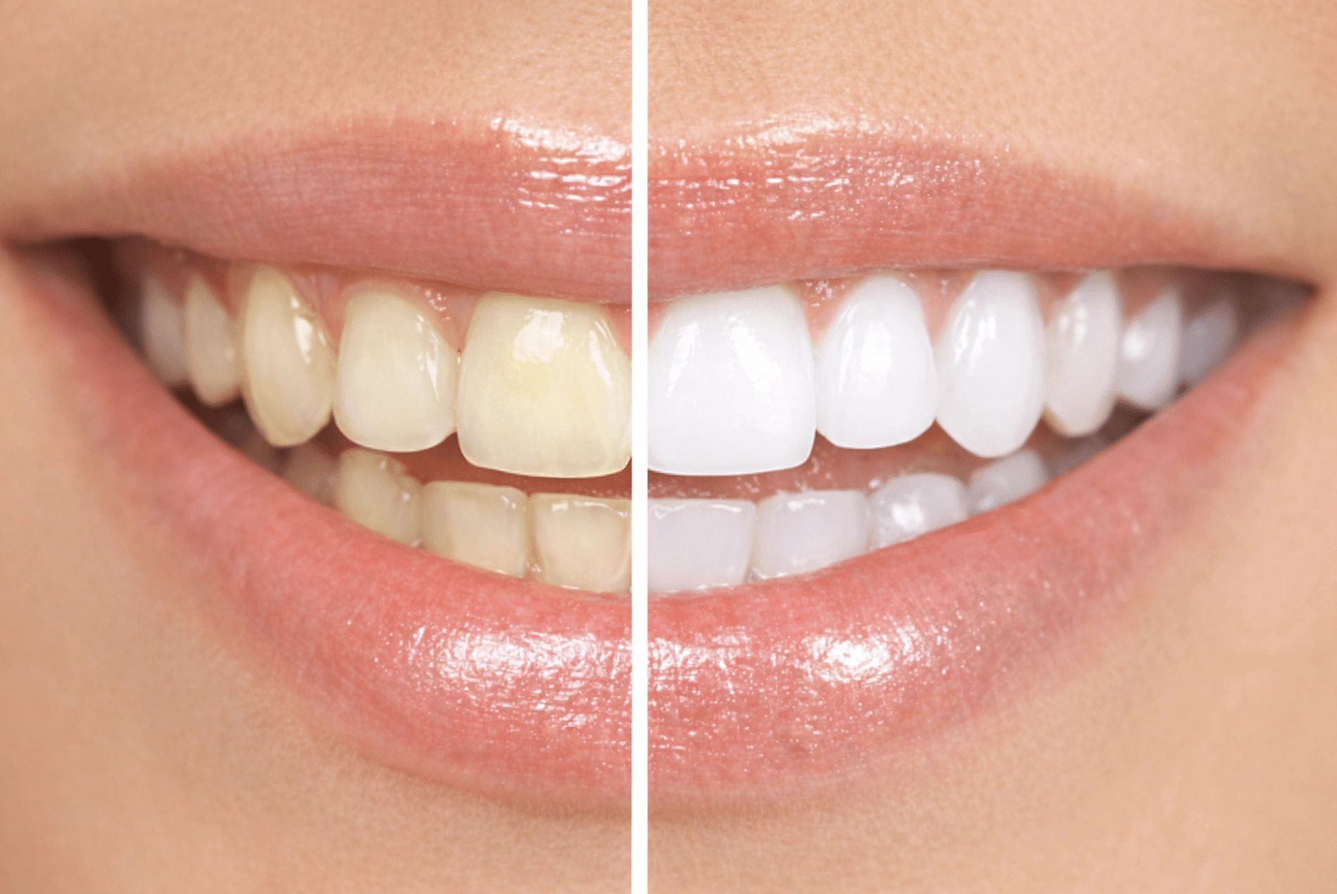 Comparison of yellowed and whitened teeth.