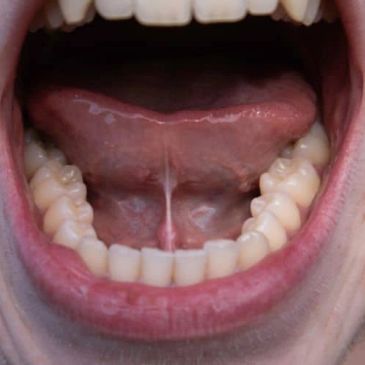 Close-up of an open mouth showing lower teeth and tongue.