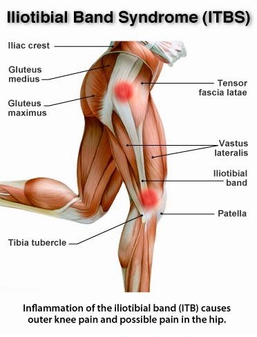 IT Band Tightness Stop Foam Rolling and Try This Instead
