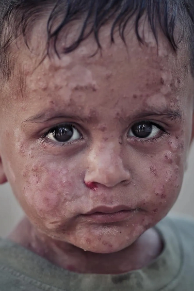child from Gaza with burn marks on face 