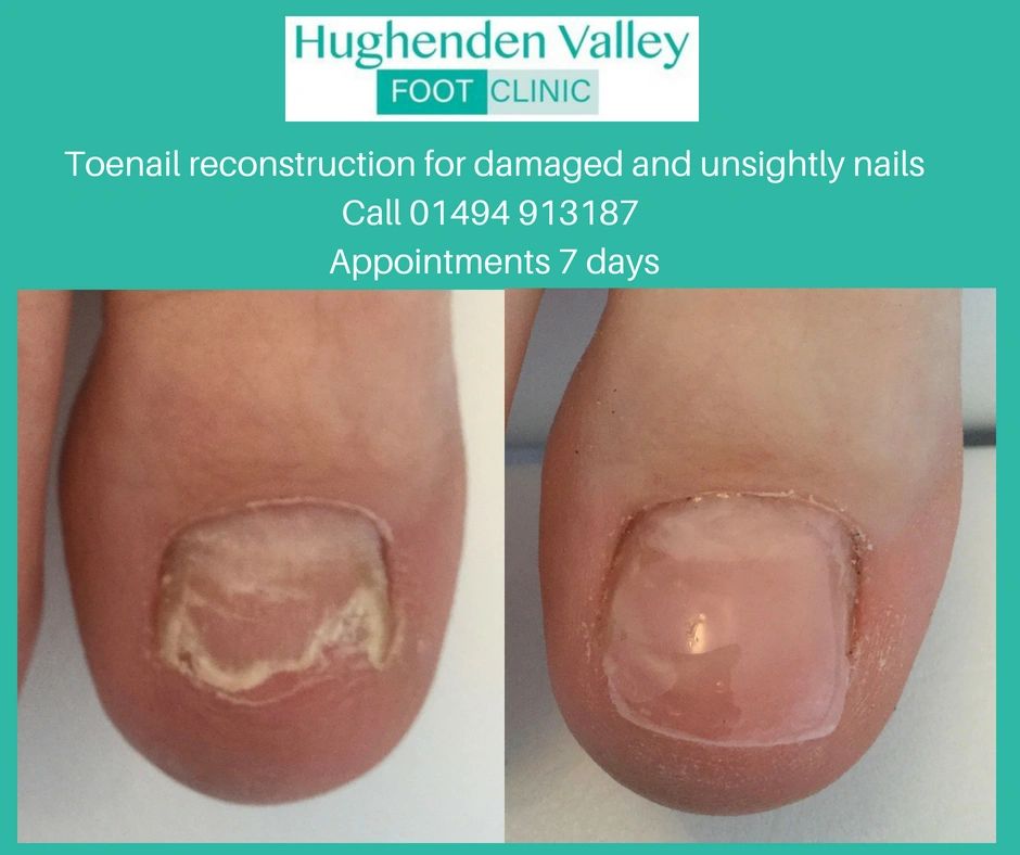 Toenail reconstruction